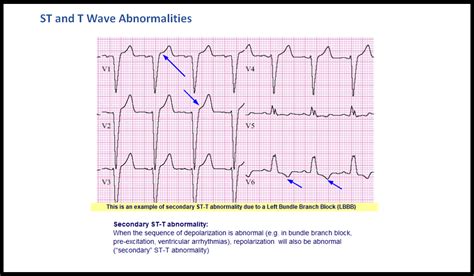 what is nonspecific st and t wave abnormality|ECG Learning Center .